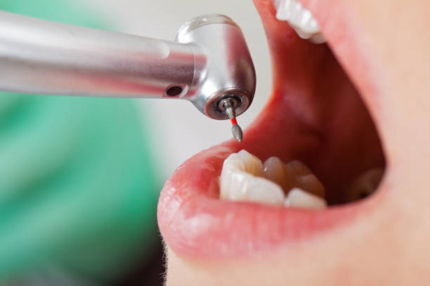 Best Emergency Tooth Extraction in Fairless Hills, PA